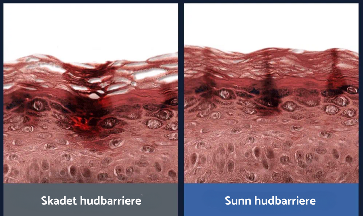 Reparerer hudbarrieren